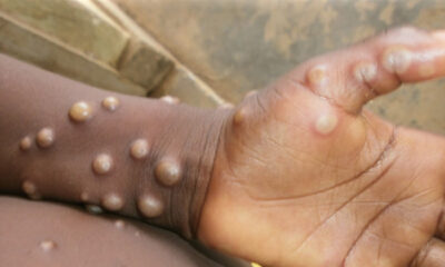 Mpox: 40 Cases Confirmed In Nigeria