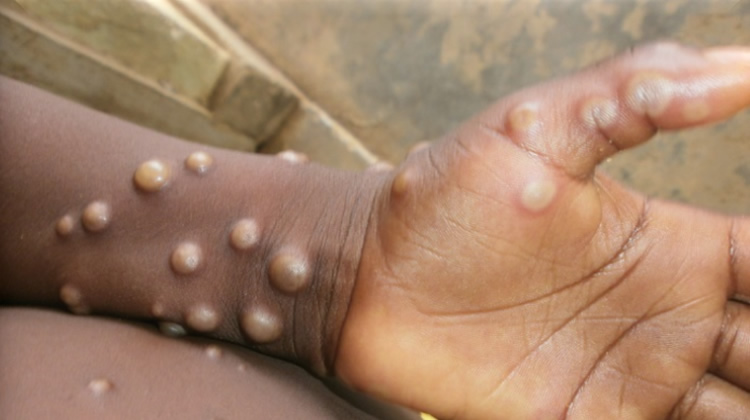 Mpox: 40 Cases Confirmed In Nigeria