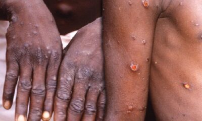 US Debunk Rumours Of Imposing Travel Restrictions On Africans Over Mpox