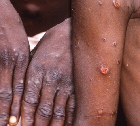 US Debunk Rumours Of Imposing Travel Restrictions On Africans Over Mpox