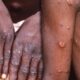 US Debunk Rumours Of Imposing Travel Restrictions On Africans Over Mpox